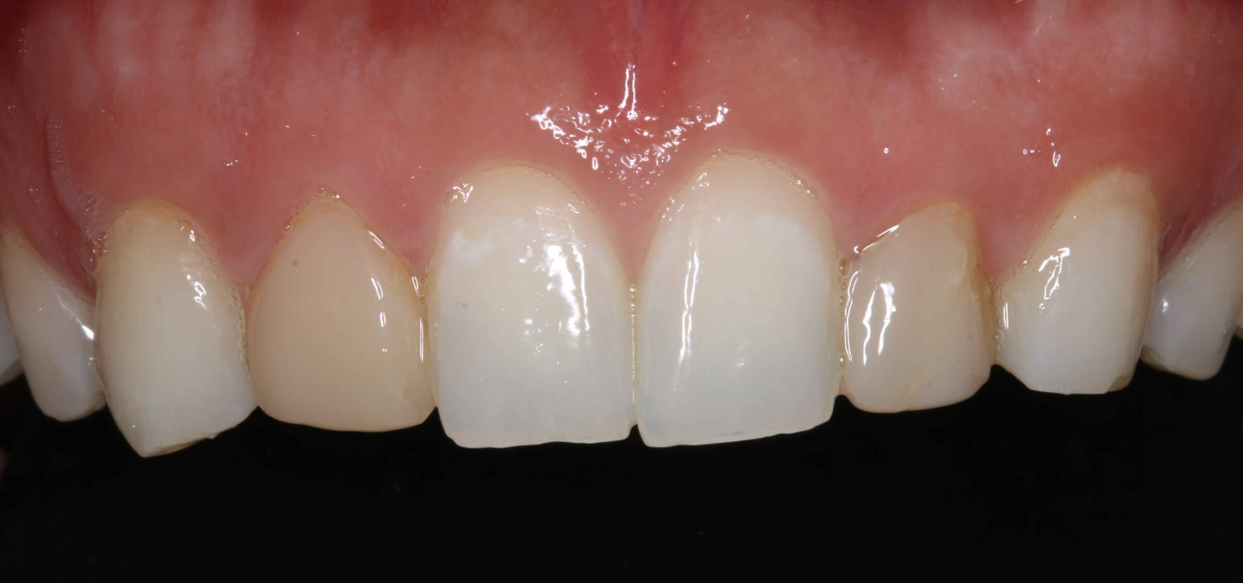 Teeth Whitening & Composite Bonding - Willow Tree Dental